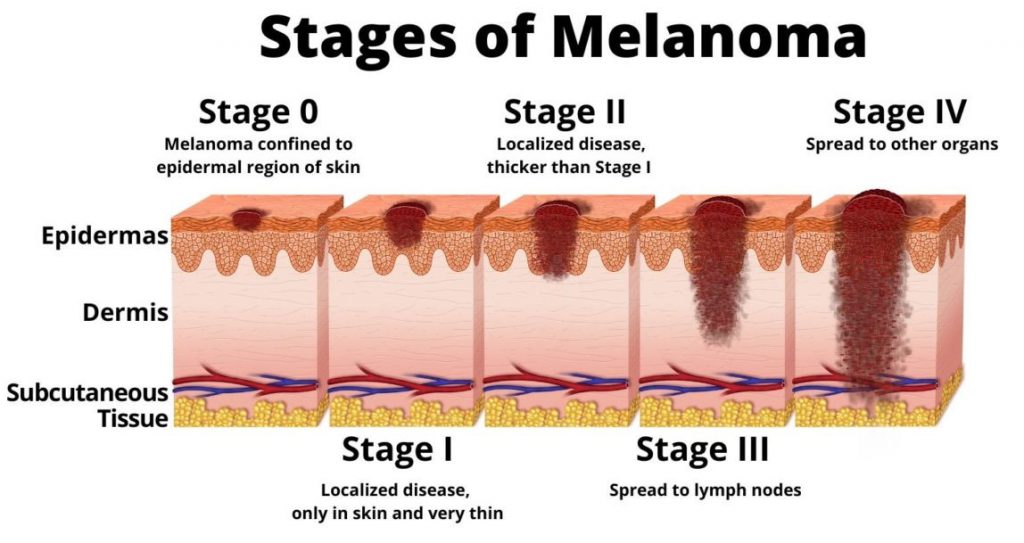 4 stages